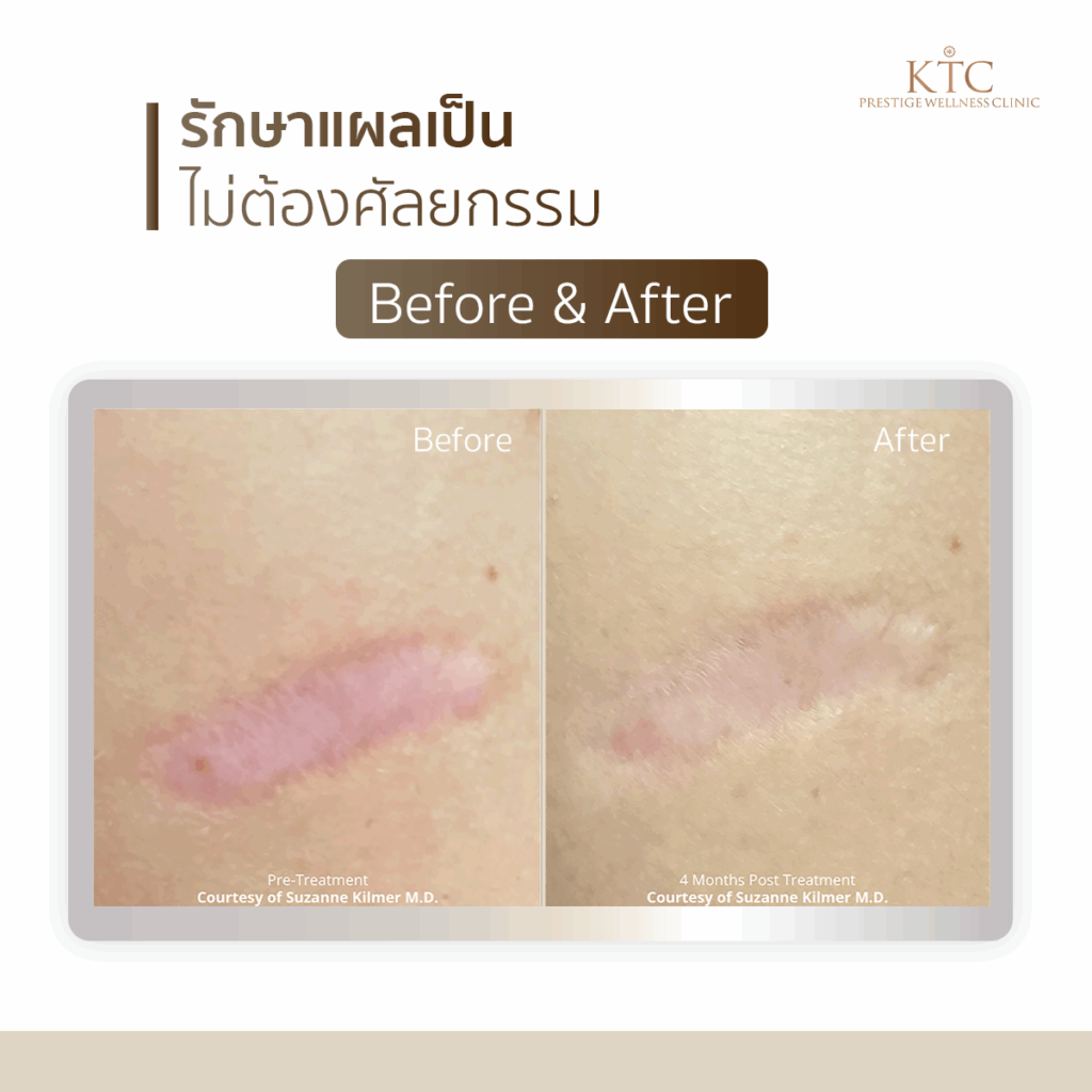 แผลเป็น ultraclear