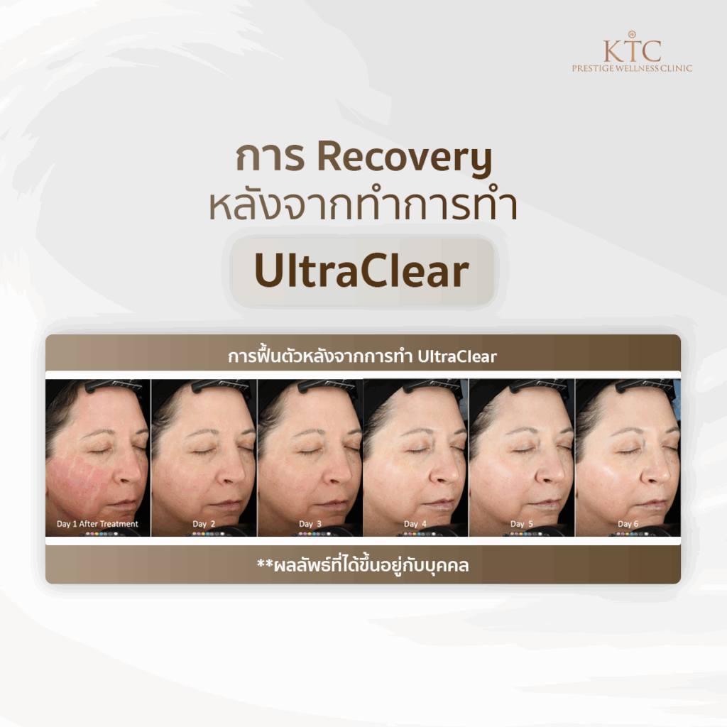 หลังการทำ ultraclear