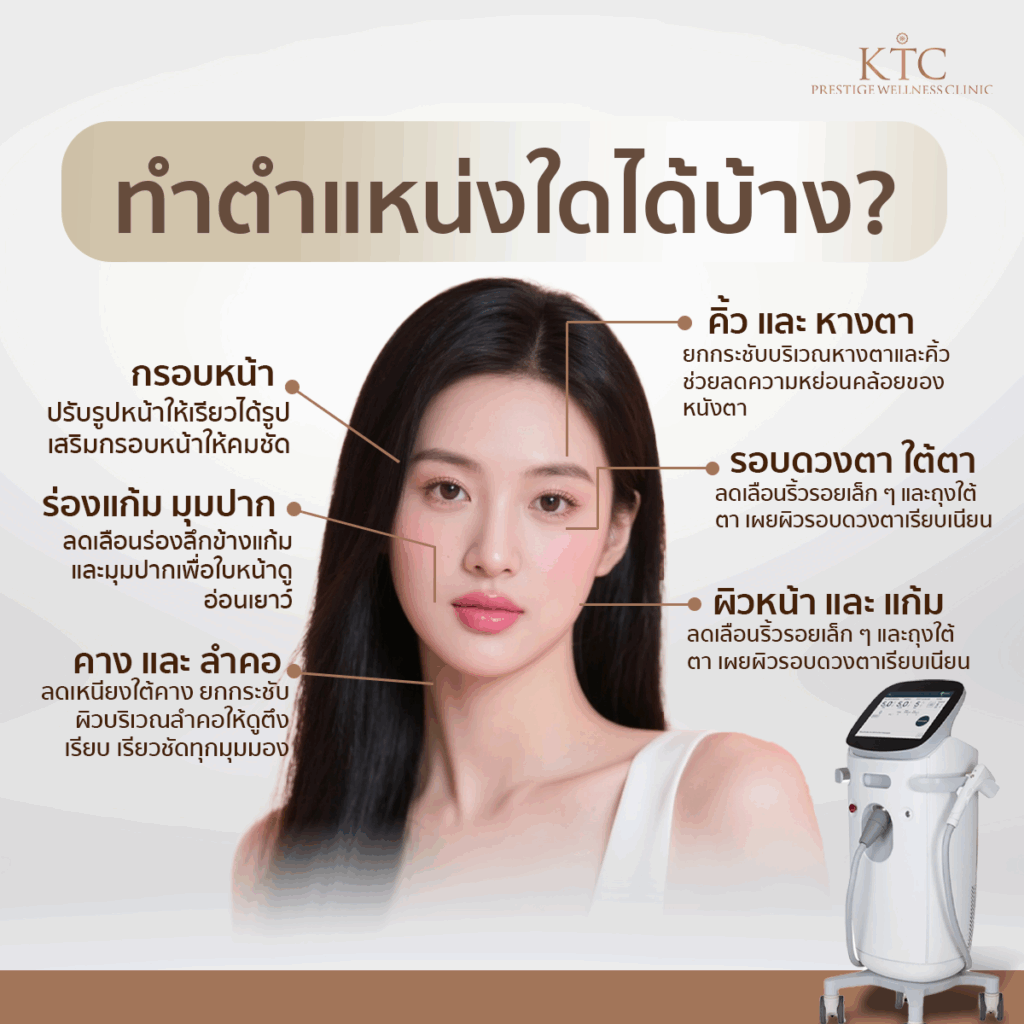 sofwave ทำตำแหน่งไหนได้บ้าง