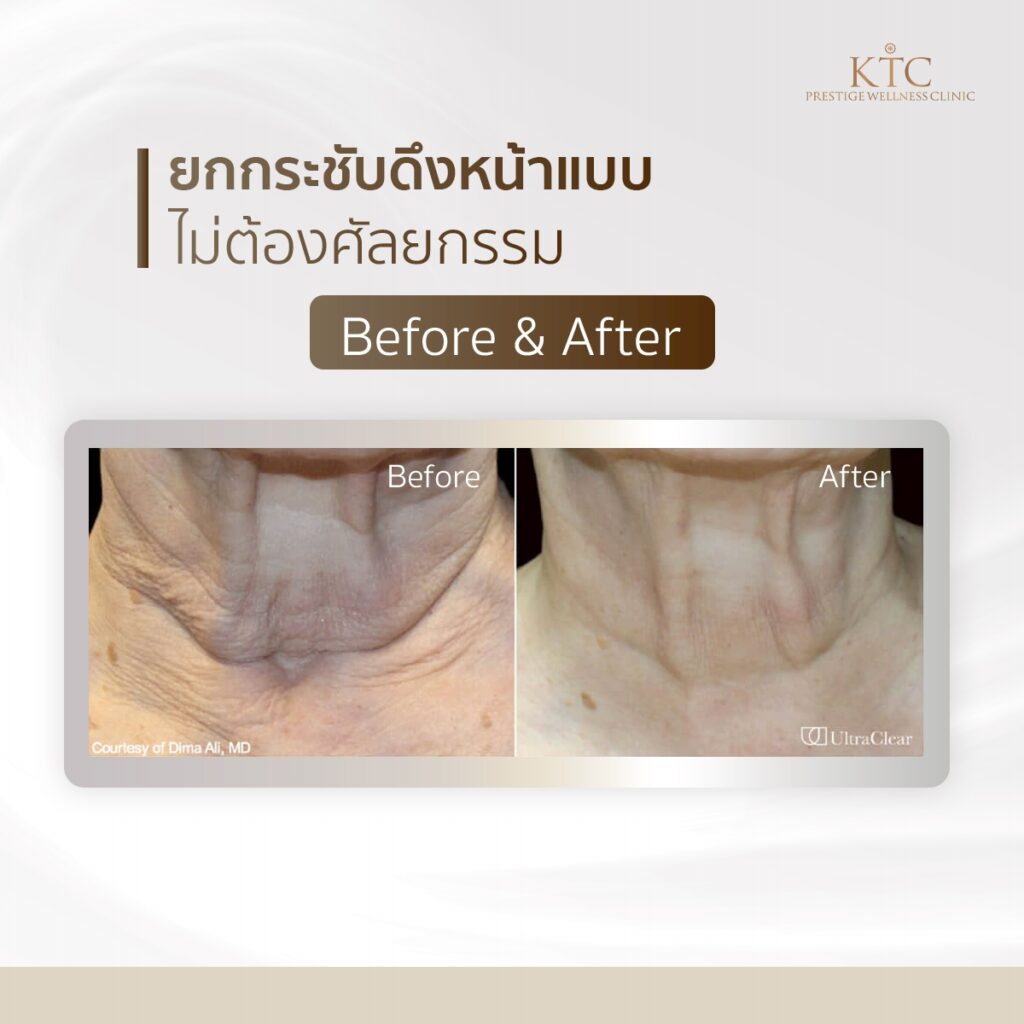 ultraclear ดึงคอ