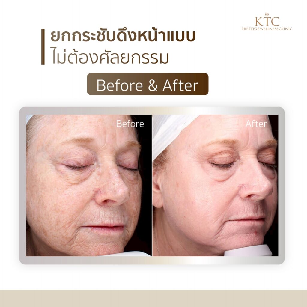 ultraclear before after