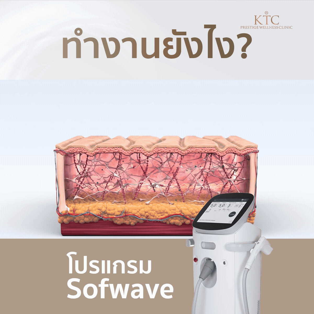 Sofwave ทำงานยังไง