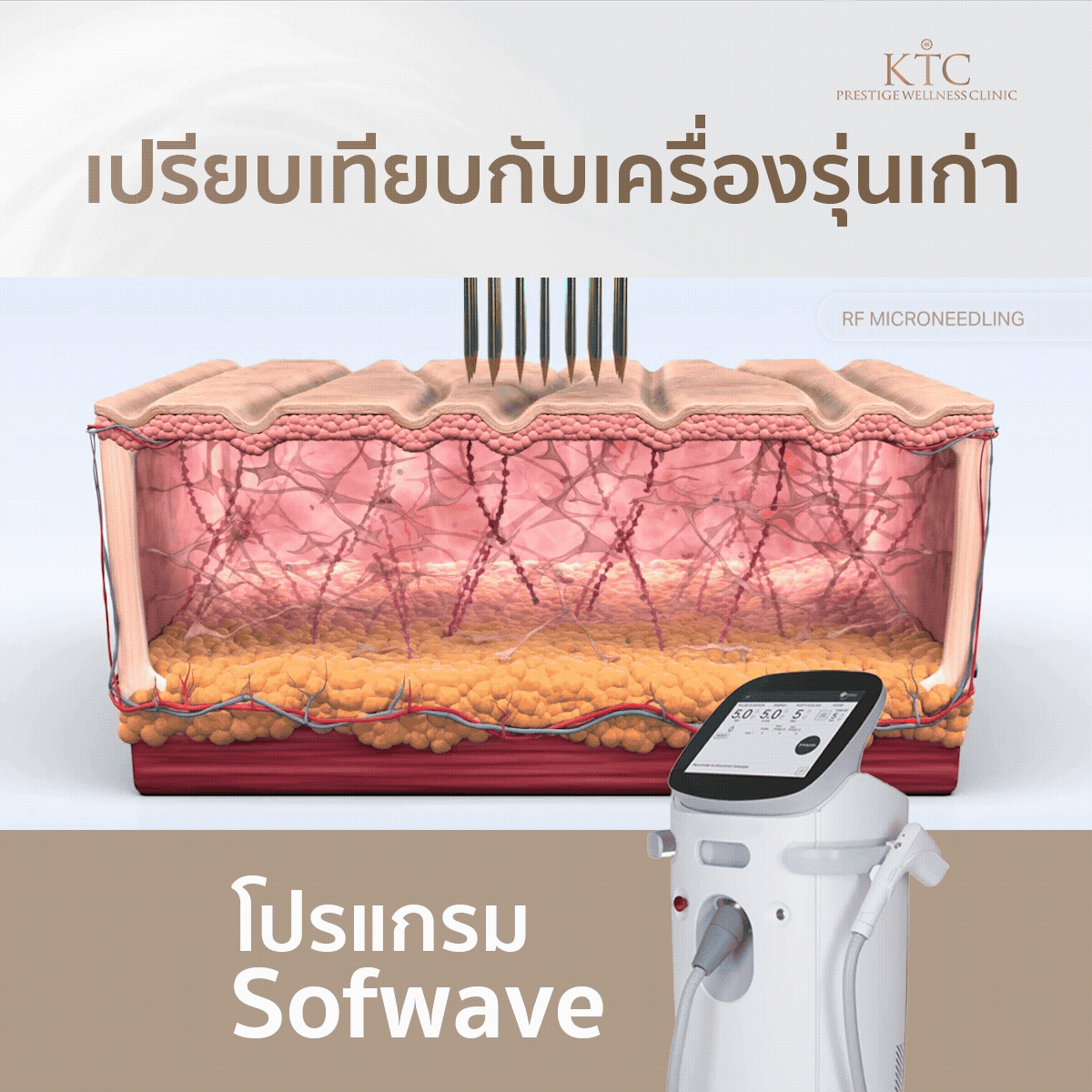 sofwaveเปรียบเทียบกับเครื่องรุ่นเก่า